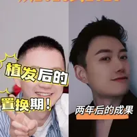 时隔两年，当年植发的那个人，现在怎么样了？
2023.12.25 植发记录，两年后交答卷。
#发际线 #拯救发际线 #头发 #说真话  #脱发