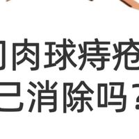 肛门肉球痔疮能自己消除吗？