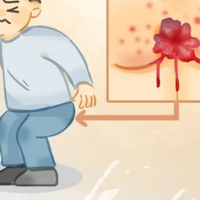 痔疮流血怎么办？分享一个自用的止血护理全攻略