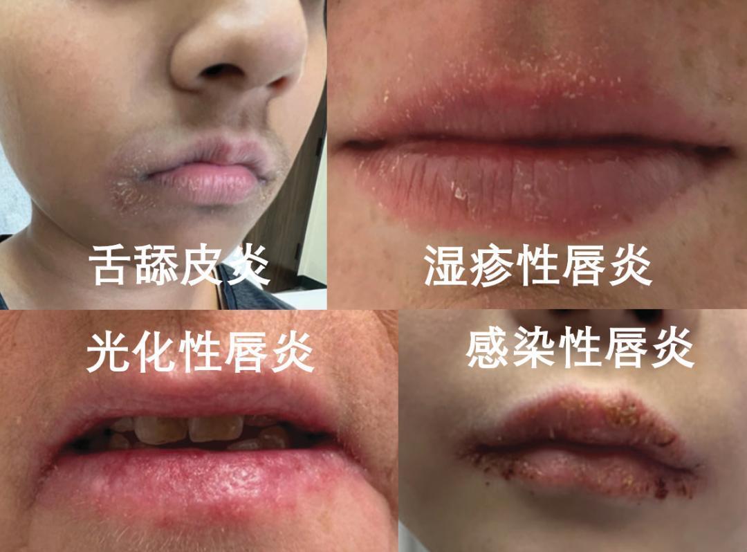 嘴唇越涂越干最后变唇炎？医生点名含这些成分的网红润唇膏：赶紧停用！