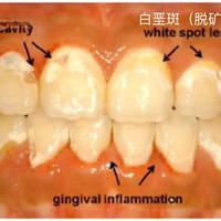 含氟牙膏防龋真相：三重作用机制与儿童安全使用关键