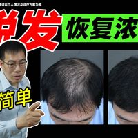 站友在我的建议下,头发已恢复到浓密