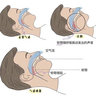 家用呼吸机：是“健康必需品”还是“智商税”？1000+用户观点大PK