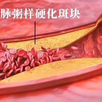 动脉硬化斑块可逆！发现：每日补充这种营养素，血管“减龄”5岁