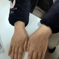 类风湿患者必看！止疼药怎么选，才能不伤胃？