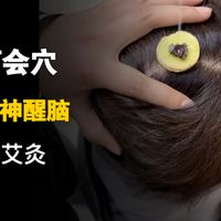 麦粒灸：百会穴，醒脑安神，缓解焦虑