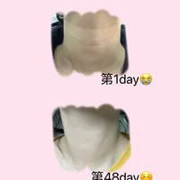 一个月生理盐水实感（颈纹）