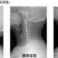 颈椎曲度变直别再乱按了！这类按摩仪不仅无效还可能加重损伤