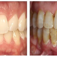 漱口水不是刷牙替代品，用错反而伤口腔——这四类人用才真有效