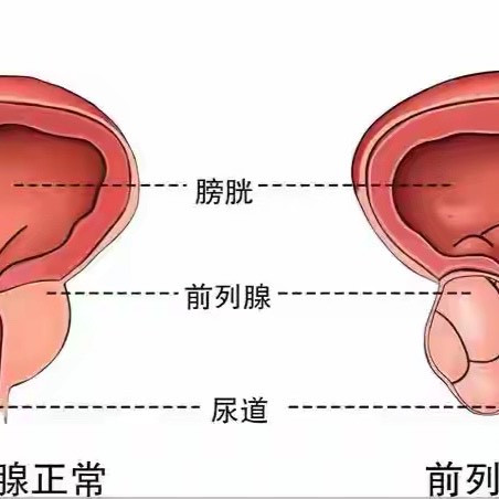 医生研究：天天坚持提肛的前列腺患者，不出半年，身体迎来4变化