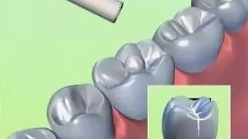 孩子窝沟封闭，百分之九十九的爸妈不当回事！