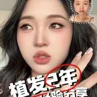 植发两年经验复盘：从术前避坑到术后护理的真实反馈