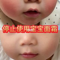 19💰娃换季红脸、黑脸、起皮上岸了