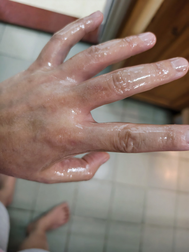 厨房急救神器！亲测有效烫伤膏🔥