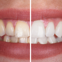 99%“去牙结石”牙膏根本碰不到牙结石，别再被忽悠了