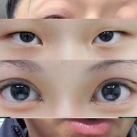 这三类人尽量别碰双眼皮