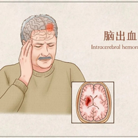 【医讯】当大脑亮“红灯”，3D打印技术来导航——让脑出血手术更精准、更安心