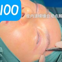 缝合技巧展示：皮内连续缝合降低疤痕增生风险。