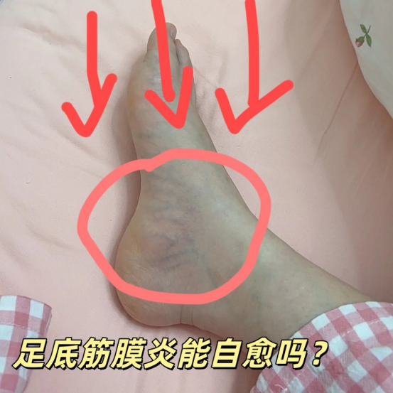 足底筋膜炎能自愈吗？日常做好这几件事！
