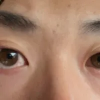 慢性结膜炎+干眼 开始治疗记录260301