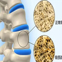 骨质疏松治疗用药指南：药物选择、剂量与疗程解析