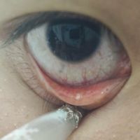 睑板腺堵塞，热敷、鱼油、早睡，终于不堵了