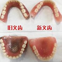 前牙修复方案对比：活动义齿与隐形义齿的深度解析