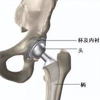 髋关节置换术后康复全指南：三阶段恢复要点与禁忌