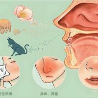 2026年春季过敏性鼻炎高发：2.6亿人如何应对花粉“渡劫期”？