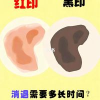 受伤后红黑印去除指南：大概多久能消？