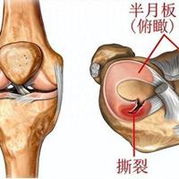 外侧半月板前角损伤：症状自查、急救与全周期康复指南