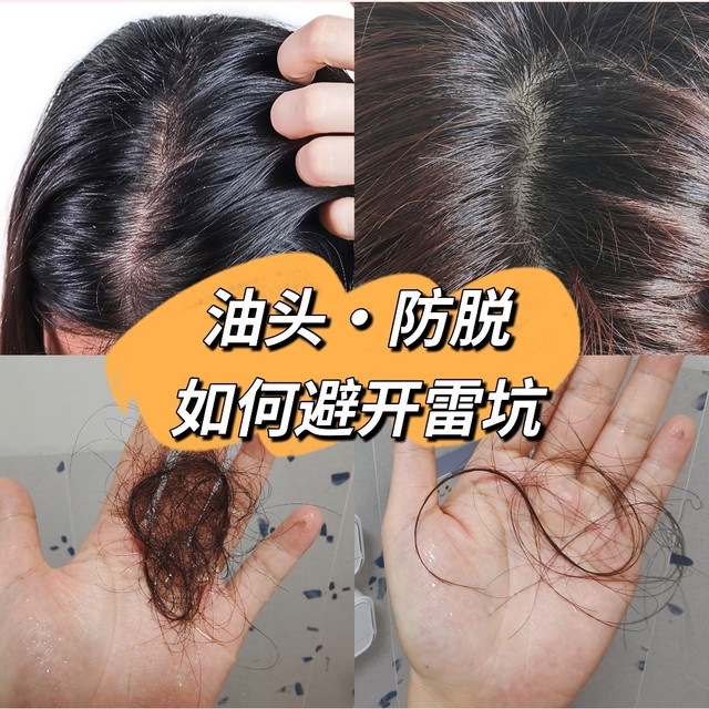 油头防脱猛怼米诺地尔，结果掉发也不见少，怎么这个坑你还在踩？
