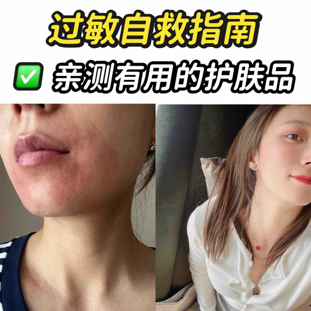 过敏自救流程，护肤品选择看这篇就够了！