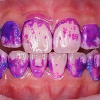 半年没洗牙，牙医却说“不用洗”？居家护理做对这3点，口腔医生尽量不见