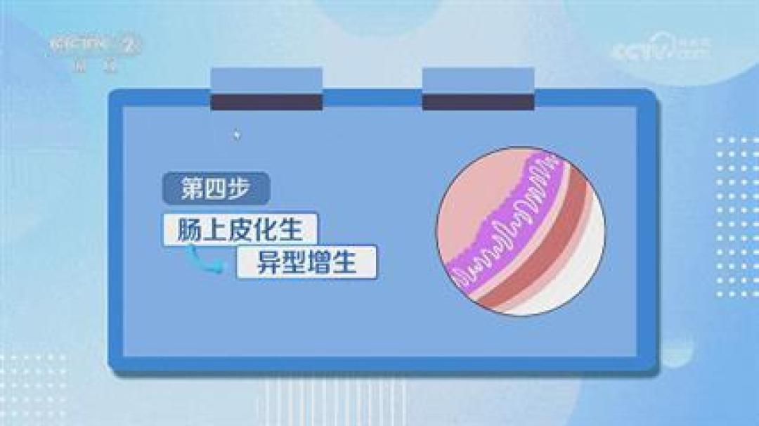 幽门螺杆菌是胃癌元凶?一文看懂如何预防、检测与彻底根治