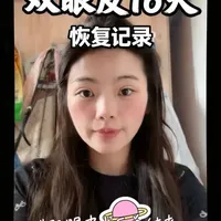 双眼皮手术全流程：从面诊决策到术后护理的实操经验