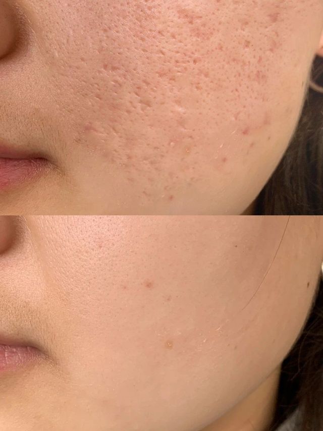 痘痘消退后，残留的红黑色痘印和痘坑怎么去掉？