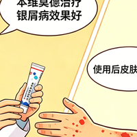 银屑病哪些部位用本维莫德效果，优于其他药膏？