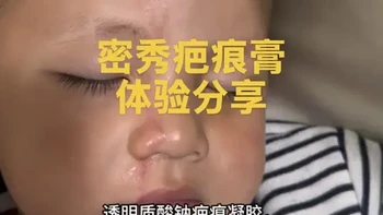 医用透明质酸钠硅酮疤痕凝胶成分与使用分析