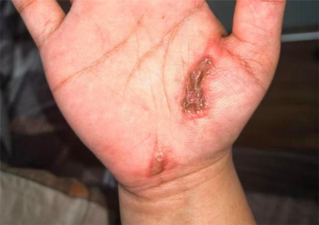 电流瞬间击穿全身!女子边充电边玩手机遭电击多处受伤