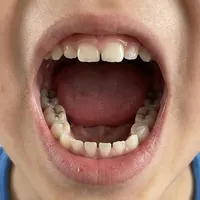 孩子牙齿出现黑线要补吗？