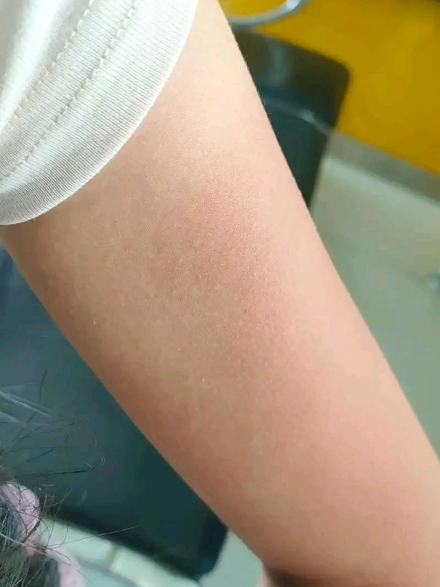 晒伤后急救修护指南｜亲测不踩坑，新手直接抄作业