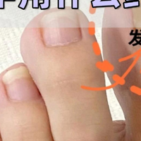 恢复白嫩亮甲，伊甲复方聚维酮碘轻松告别灰指甲困扰