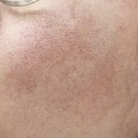皮肤屏障受损修复