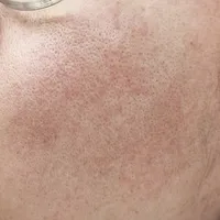 皮肤屏障受损修复