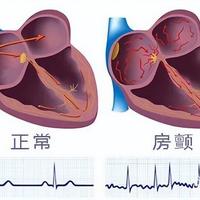 人不会无故得房颤！调查发现：房颤人群，多半有这5个共同点