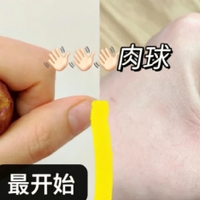 7年痔疮拉锯战，给大家分享一下我的上岸经验