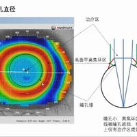 眼科专家梅颖教授讲解《当角膜塑形遇上视功能训练》