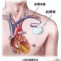 起搏器别盲目追新！95%的人更适合传统款，省下十几万还更安全