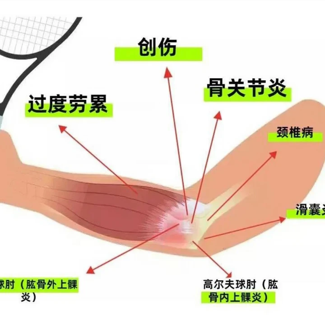 手臂一抬就疼？小心网球肘！学会这两招，轻松“自救”不犯愁